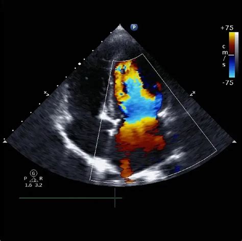 normal 2d echo result|Interpreting Echocardiogram Results: A Comprehensive Guide for .